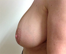 Side view of breast before breast reduction surgery