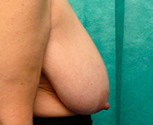 Side view before breast reduction surgery